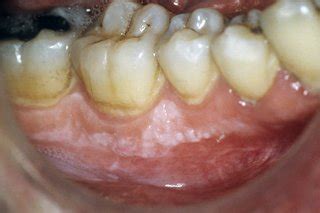 leucoplazia varicoasă a limbii